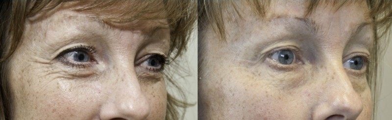 exilis ultra avant après yeux
