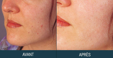 microdermabrasion avant après