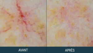 thermocoagulation vaisseaux avant après